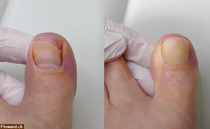 Bild 1: Nagelprothetik - abgebrochene Nägel künstlich aufbauen